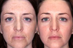 Medical Grade Chemical Peels Photos Thumbnail