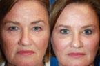 Medical Grade Chemical Peels Photos Thumbnail